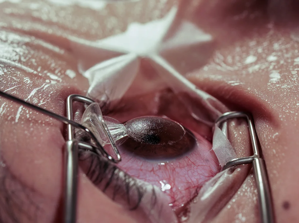How Much Is Laser Eye Surgery Without Private Health Cover?